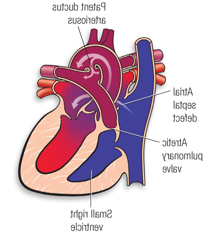 Pulmonary atresia diagram