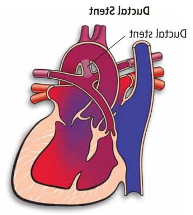 illustration of ductal stent
